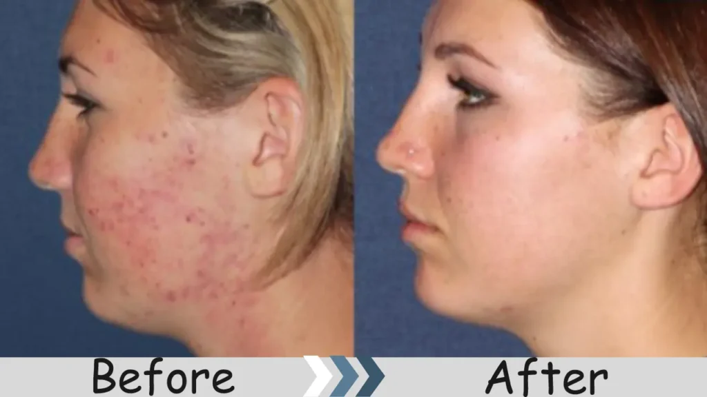Before After of Acne Treatment