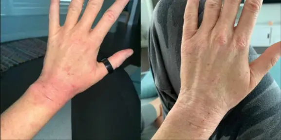 Before and After Psoriasis