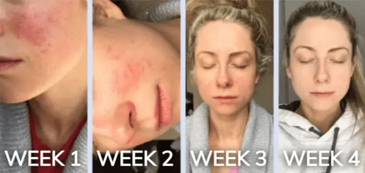 Rosacea Treatment