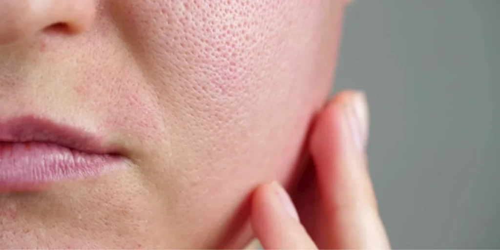 Clogged Pores